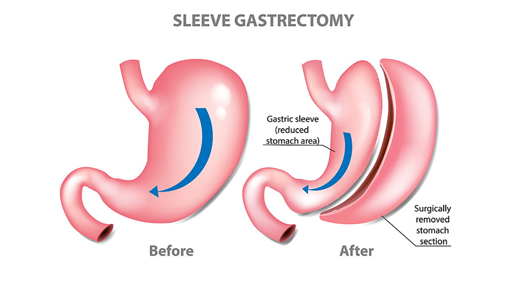 Gastric Sleeve Surgery