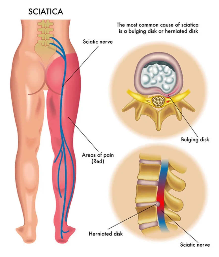 What-Exactly-is-Sciatica